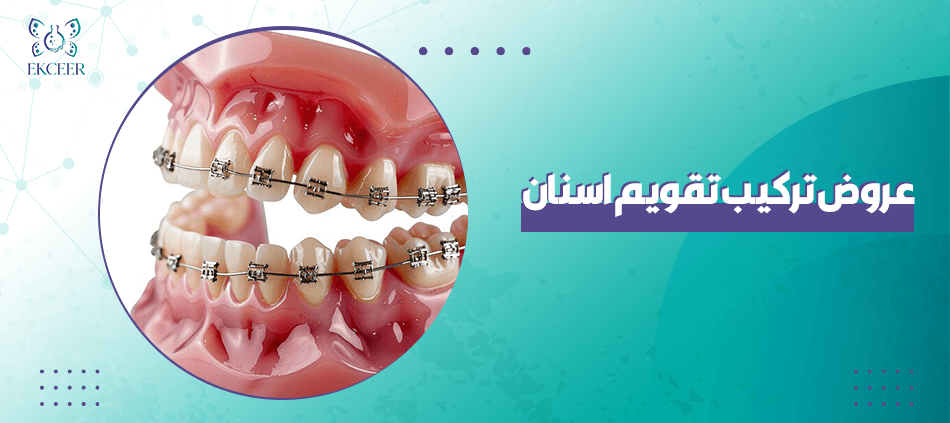 عروض تركيب تقويم اسنان